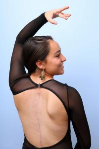 Olivia wears her leotard and dance costume proudly as she shows off her surgery scar.